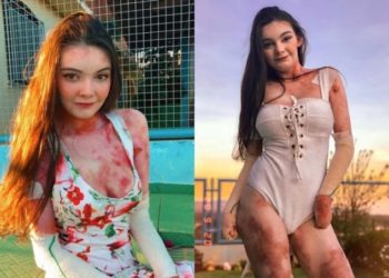 “내 외모 부끄럽지 않아”… ‘온몸 물집’ 희귀병 극복한 브라질 여성